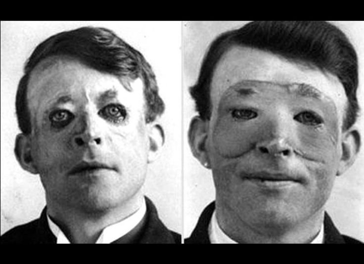The photograph proves that first plastic surgery was conducted in the year of 1917 (736*534)